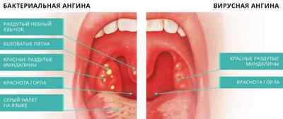 Ангіна без болю в горлі: інші симптоми і лікування