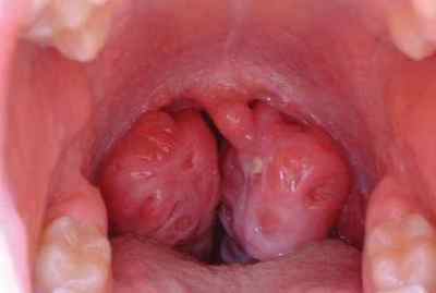 Ангіна Людвіга (флегмона дна порожнини рота): особливості, діагностика та лікування ротової флегмони