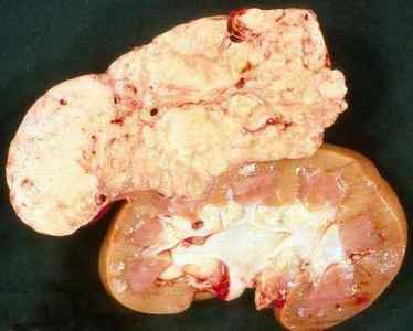Ангіоміоліпома нирки (лівої і правої): що це таке?
