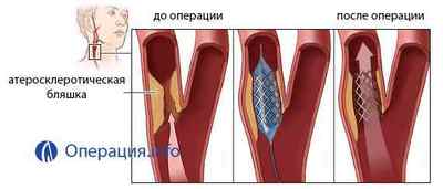Ангіопластика судин (артерій): коронарних, нижніх кінцівок, сонних