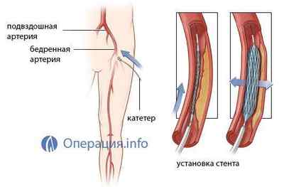 Ангіопластика судин (артерій): коронарних, нижніх кінцівок, сонних