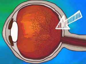 Ангіоспазм сітківки ока: симптоми і лікування судин очного дна
