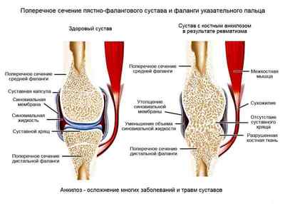 Анкілоз суглоба: що це таке, лікування СНЩС, тазобедернного і гомілковостопного суглобів | Ревматолог