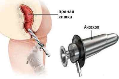 Аноскопія: суть процедури, підготовка і проведення обстеження