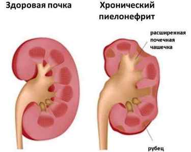 Антибіотики при пієлонефриті нирок
