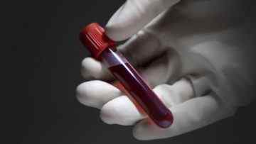Антитіла до токсокар: аналіз крові до антигенів на токсокароз 1400 що це