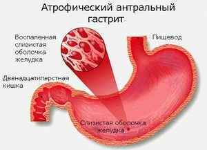 Антральний атрофічний гастрит: що це таке, типи і причини розвитку, симптоми, діагностика, лікування