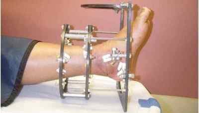 Апарат Ілізарова: що це таке, фото на нозі й руці, скільки коштує, як ставлять і знімають апарат, альтернатива апарату Ілізарова | Ревматолог