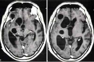 Арахноідальная кіста головного мозку, види і причини, симптоми і лікування