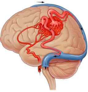 Артеріовенозна мальформация судин головного мозку