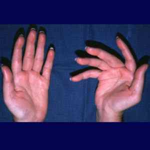 Артрит кисті руки: симптоми і лікування народними засобами, остеоартрит, ревматоїдний артрит, вправи на початковій стадії | Ревматолог