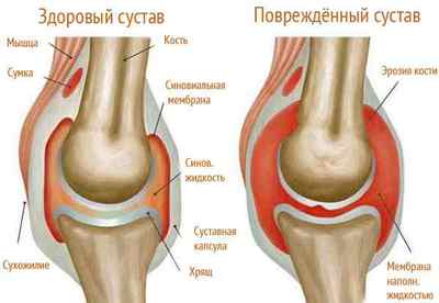 Артрит колінних суглобів: симптоми і лікування народними засобами в домашніх умовах, діагностика, фото і види, причини | Ревматолог