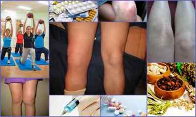 Артрит колінного суглоба: симптоми, лікування, діагностика, фото, причини