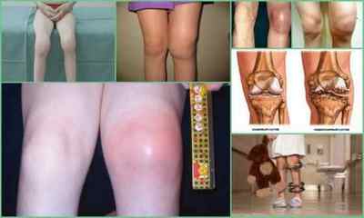 Артрит колінного суглоба у дітей: причини, симптоми, лікування