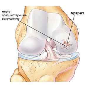Артрит лучезапястного суглоба: профілактика артрозу і артритів, симптоми і лікування, препарати та фото | Ревматолог
