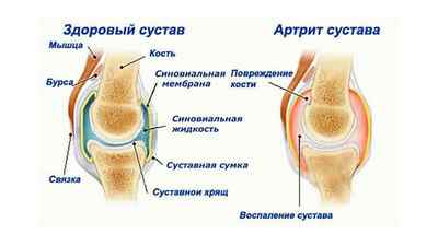 Артрит ніг: симптоми і лікування, ознаки ревматоїдного артриту ноги | Ревматолог