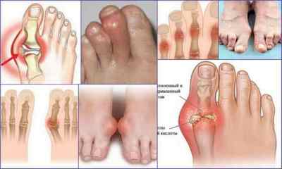 Артрит пальців ніг: симптоми, лікування, причини, фото