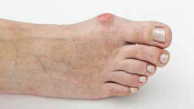 Артрит пальців ніг: симптоми і лікування в домашніх умовах народними засобами, фото, чим і як лікувати артрит великого пальця ноги | Ревматолог