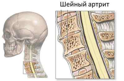 Артрит шийного відділу хребта: симптоми і лікування, ревматоїдний артрит спини, апарат іонізатор, діагностика артриту шиї | Ревматолог