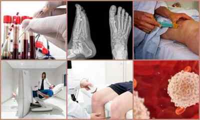 Артрит суглобів: симптоми і ознаки, лікування, фото, причини, діагностика, профілактика