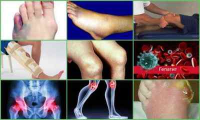Артрит суглобів: симптоми і ознаки, лікування, фото, причини, діагностика, профілактика