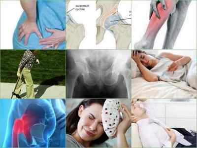 Артрит тазостегнового суглоба: симптоми, лікування, причини, діагностика, фото