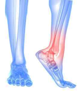 Артродез гомілковостопного суглоба: відгуки пацієнтів, що таке артродез колінного суглоба, артродез хребта і наслідки | Ревматолог