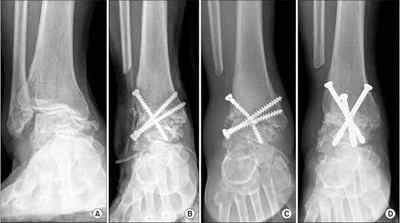 Артродез гомілковостопного суглоба: відгуки пацієнтів, що таке артродез колінного суглоба, артродез хребта і наслідки | Ревматолог