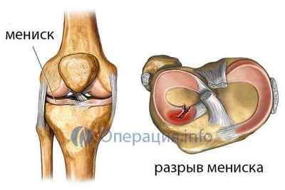 Артроскопія меніска (колінного суглоба): показання, проведення, реабілітація