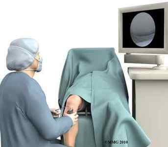 Артроскопія меніска (колінного суглоба): показання, проведення, реабілітація