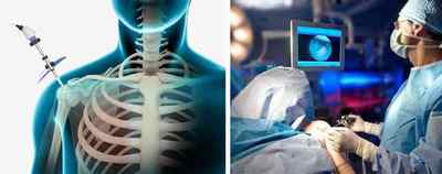 Артроскопія плечового суглоба: показання, операція