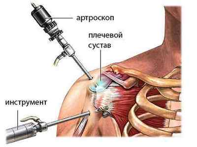 Артроскопія плечового суглоба: показання, операція