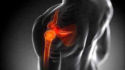 Артроскопія плечового суглоба: відгуки про операцію, вправи і реабілітація після артроскопії, ЛФК та розробка плеча | Ревматолог