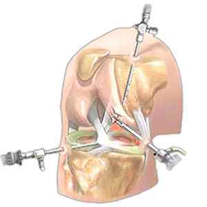 Артроскопія плечового суглоба: відгуки про операцію, вправи і реабілітація після артроскопії, ЛФК та розробка плеча | Ревматолог