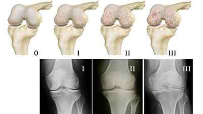 Артроз колінного суглоба 2 ступеня: симптоми і лікування, ліки та препарати, фізіотерапія, гімнастика, гострий артроз | Ревматолог