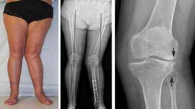 Артроз колінного суглоба 2 ступеня: симптоми і лікування, ліки та препарати, фізіотерапія, гімнастика, гострий артроз | Ревматолог