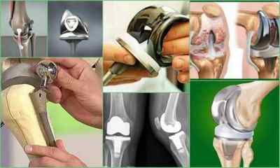 Артроз колінного суглоба: симптоми, лікування, причини, діагностика, фото, відгуки