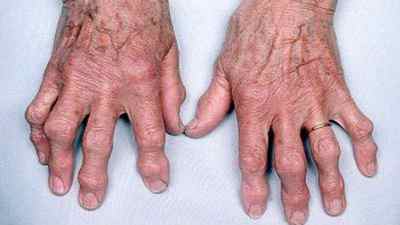 Артроз пальців рук: симптоми і лікування народними засобами, фото і причини, різартроз артроз великого пальця, гімнастика | Ревматолог