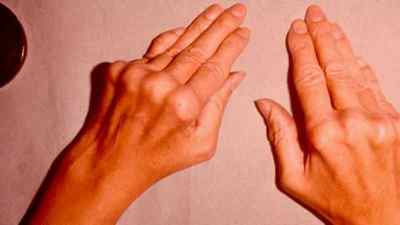 Артроз пальців рук: симптоми і лікування народними засобами, фото і причини, різартроз артроз великого пальця, гімнастика | Ревматолог