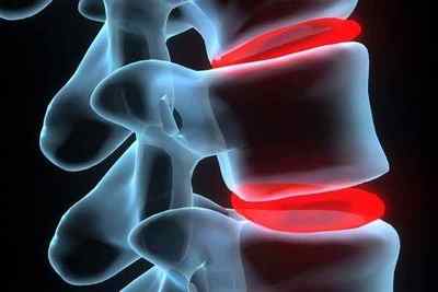 Артроз реберно-хребетних суглобів: лікування артрозу грудного відділу, реберно-поперечних суглобів і зчленувань | Ревматолог