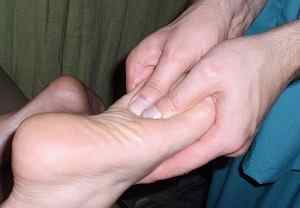 Артроз великого пальця ноги: лікування і симптоми, фото стопи і народні засоби, деформація суглоба | Ревматолог