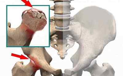 Асептичний некроз колінного суглоба: лікування народними засобами, що таке некроз кісток, остеонекроз, некроз головки плечової кістки | Ревматолог