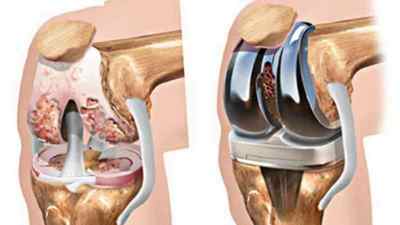 Асептичний некроз колінного суглоба: лікування народними засобами, що таке некроз кісток, остеонекроз, некроз головки плечової кістки | Ревматолог