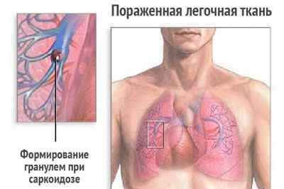 Аспергільоз легень у людини: симптоми і лікування