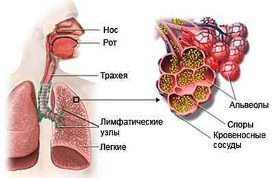 Аспергільоз легень у людини: симптоми і лікування