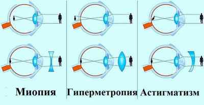 Астенопія очей (акомодаційна, аккомодатівная, мязова): лікування, симптоми