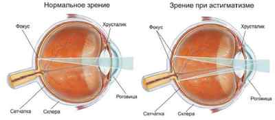 Астигматизм очей: що це за хвороба, причини і симптоми, тести, фото