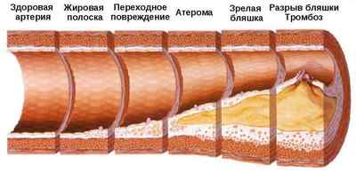 Атеросклероз судин головного мозку: симптоми і лікування
