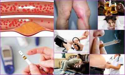 Атеросклероз судин нижніх кінцівок: симптоми і лікування, причини, діагностика, профілактика
