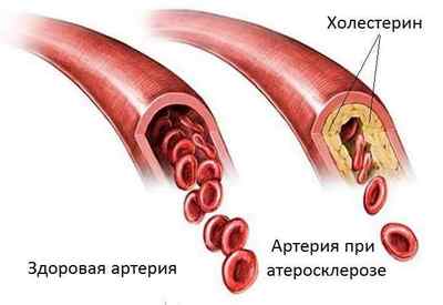 Атеросклероз судин: причини, симптоми, лікування